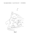 SURGICAL GUIDE AND METHOD FOR GUIDING A THERAPY DELIVERY DEVICE INTO THE     PTERYGOPALATINE FOSSA diagram and image