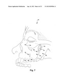 SURGICAL GUIDE AND METHOD FOR GUIDING A THERAPY DELIVERY DEVICE INTO THE     PTERYGOPALATINE FOSSA diagram and image