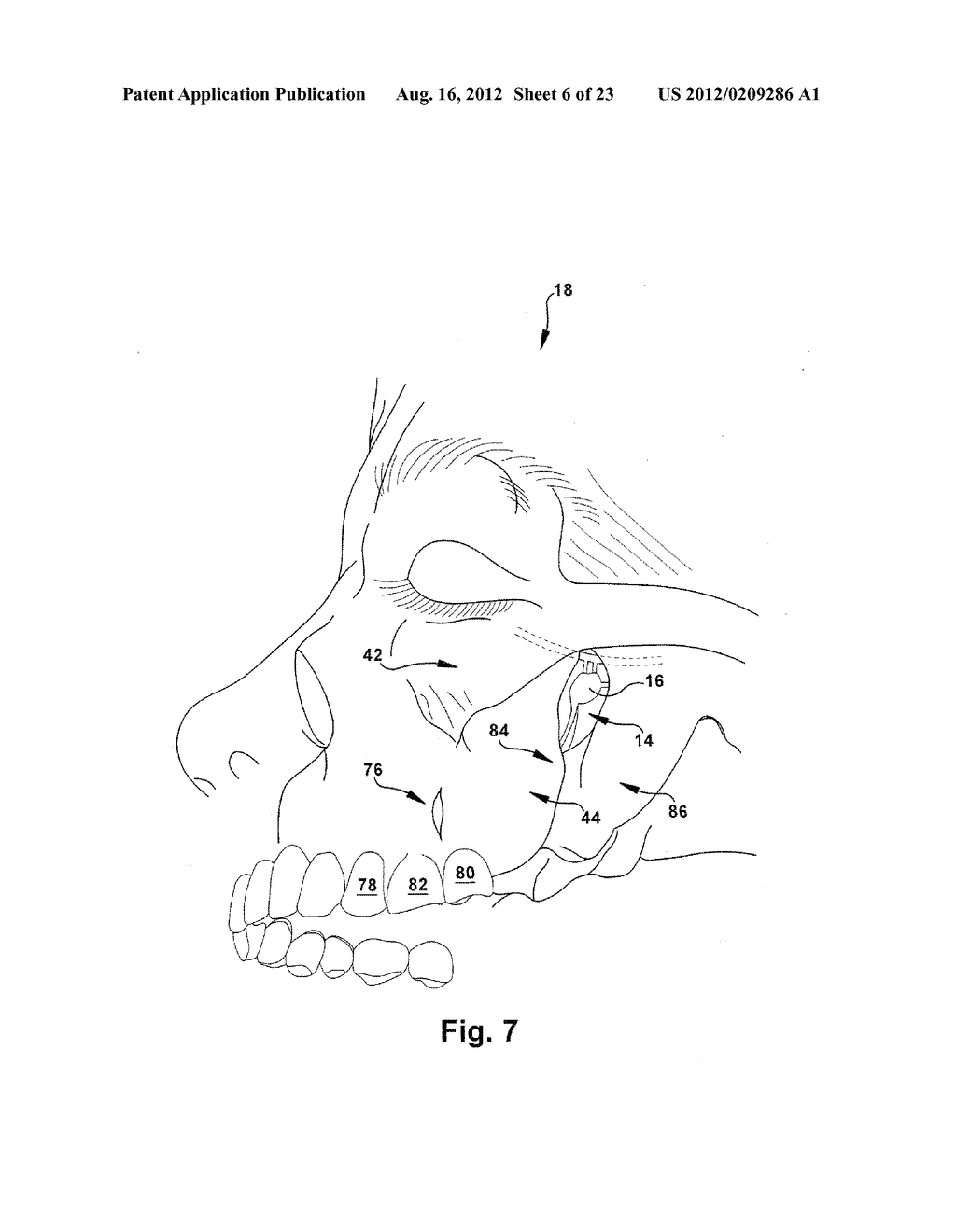 SURGICAL GUIDE AND METHOD FOR GUIDING A THERAPY DELIVERY DEVICE INTO THE     PTERYGOPALATINE FOSSA - diagram, schematic, and image 07