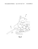 SURGICAL GUIDE AND METHOD FOR GUIDING A THERAPY DELIVERY DEVICE INTO THE     PTERYGOPALATINE FOSSA diagram and image