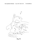 SURGICAL GUIDE AND METHOD FOR GUIDING A THERAPY DELIVERY DEVICE INTO THE     PTERYGOPALATINE FOSSA diagram and image