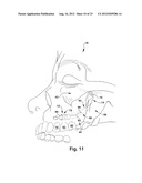 SURGICAL GUIDE AND METHOD FOR GUIDING A THERAPY DELIVERY DEVICE INTO THE     PTERYGOPALATINE FOSSA diagram and image
