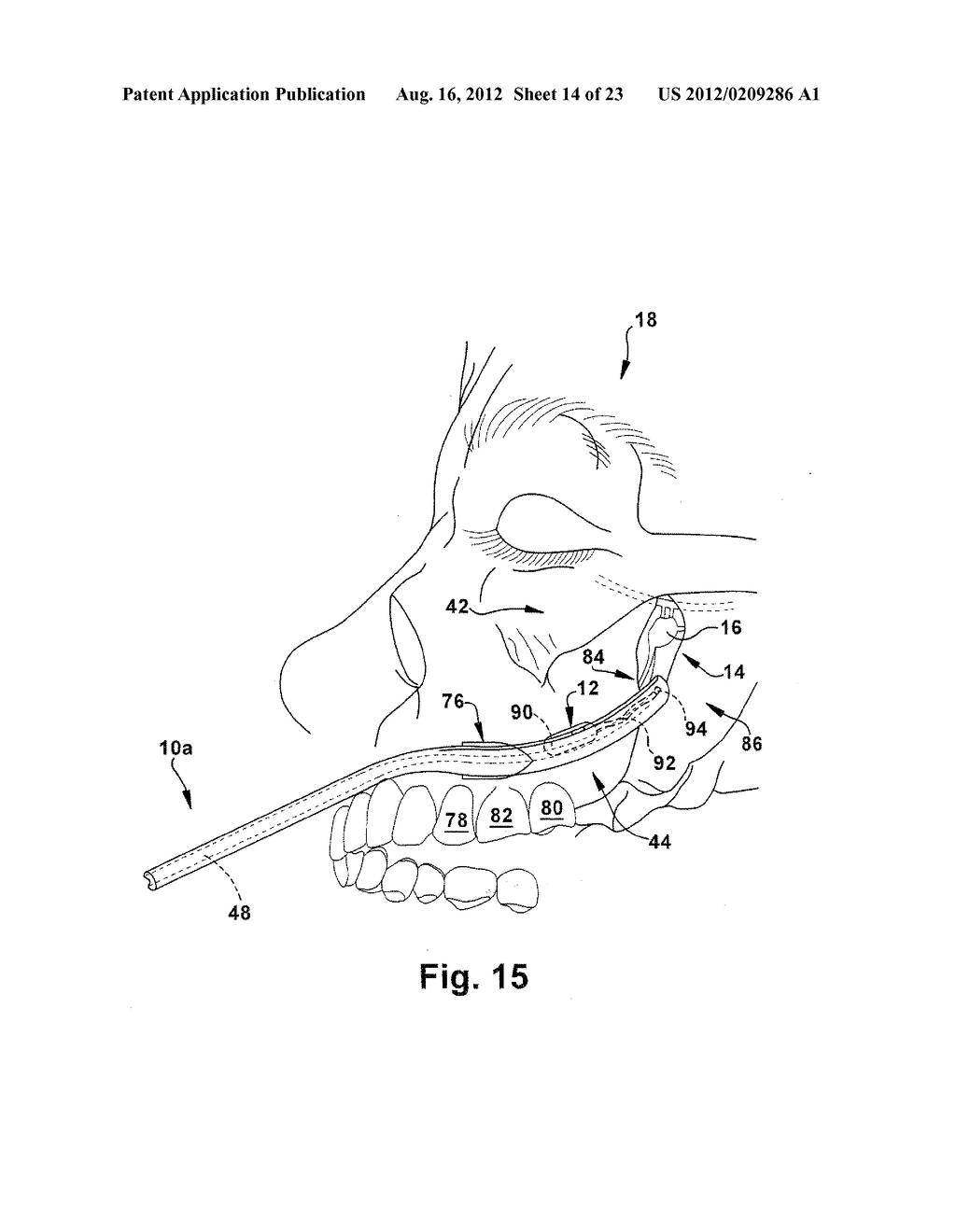 SURGICAL GUIDE AND METHOD FOR GUIDING A THERAPY DELIVERY DEVICE INTO THE     PTERYGOPALATINE FOSSA - diagram, schematic, and image 15