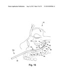 SURGICAL GUIDE AND METHOD FOR GUIDING A THERAPY DELIVERY DEVICE INTO THE     PTERYGOPALATINE FOSSA diagram and image