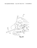 SURGICAL GUIDE AND METHOD FOR GUIDING A THERAPY DELIVERY DEVICE INTO THE     PTERYGOPALATINE FOSSA diagram and image