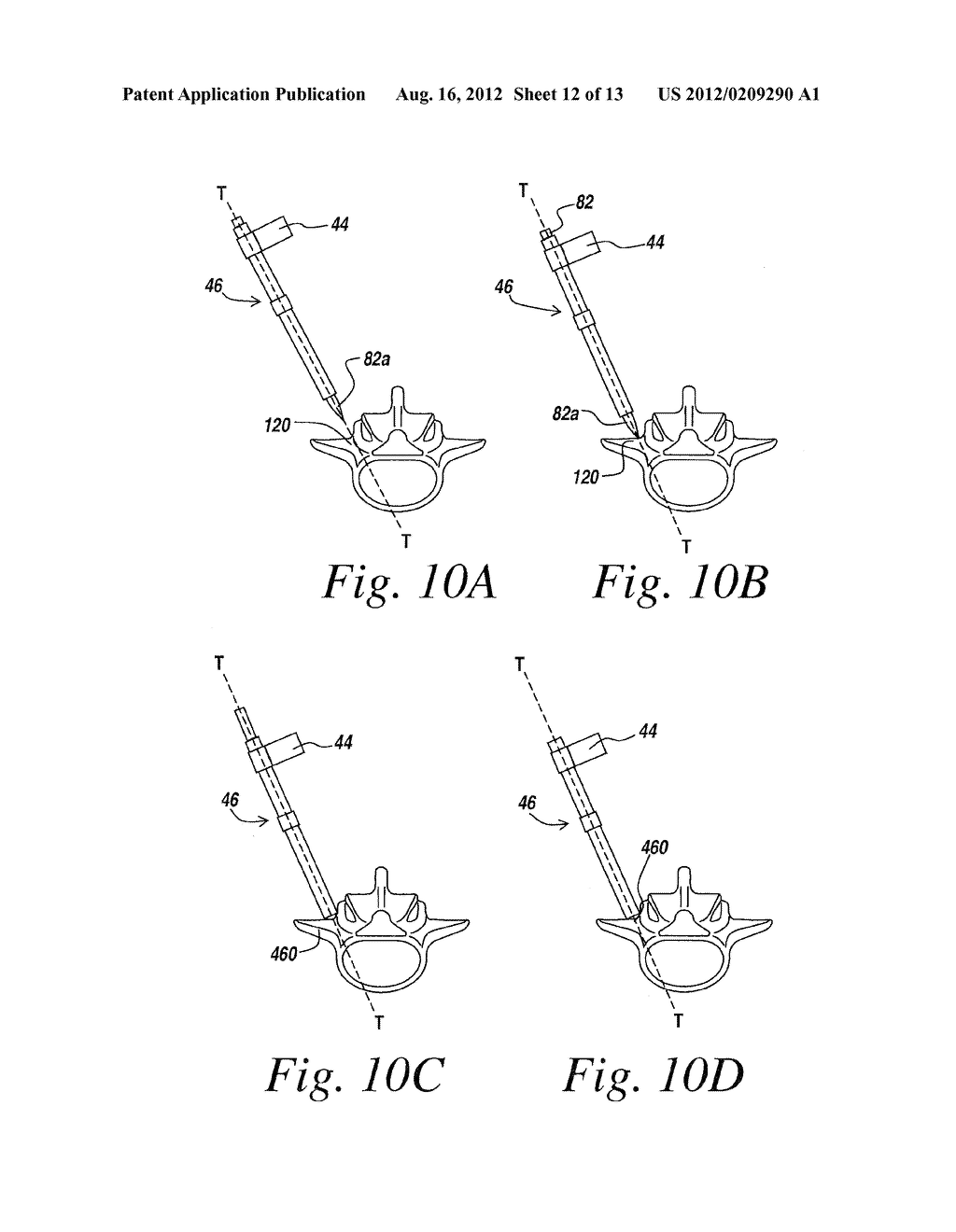 RIGIDLY GUIDED IMPLANT PLACEMENT - diagram, schematic, and image 13