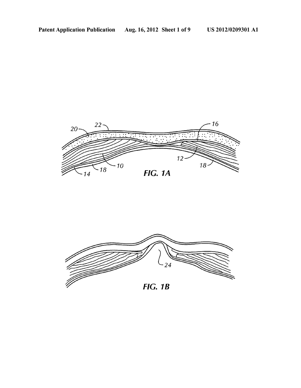 IMPLANT FOR HERNIA REPAIR - diagram, schematic, and image 02