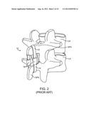 STRUCTURES AND METHODS FOR CONSTRAINING SPINAL PROCESSES WITH SINGLE     CONNECTOR diagram and image