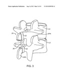 STRUCTURES AND METHODS FOR CONSTRAINING SPINAL PROCESSES WITH SINGLE     CONNECTOR diagram and image