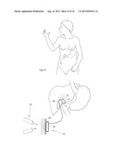 METHOD FOR THE TREATMENT OF GALLSTONES diagram and image