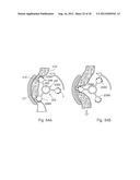 METHOD FOR THE TREATMENT OF GALLSTONES diagram and image