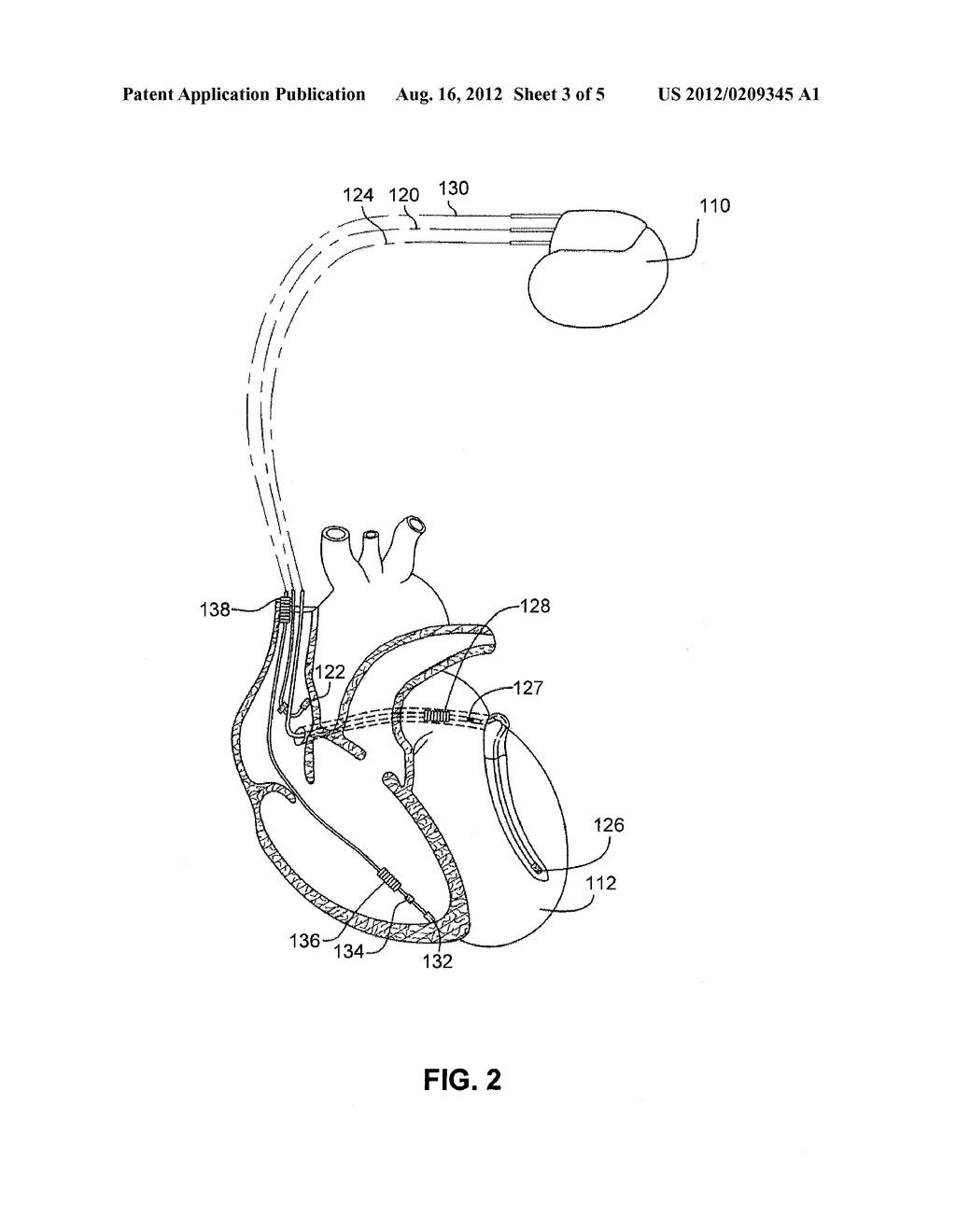 SYSTEMS AND METHODS FOR REDUCING OCCURRENCES OF ATRIAL ARRHYTHMIAS - diagram, schematic, and image 04