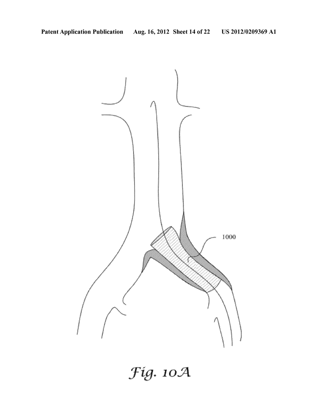 FENESTRATED ENDOGRAFT - diagram, schematic, and image 15