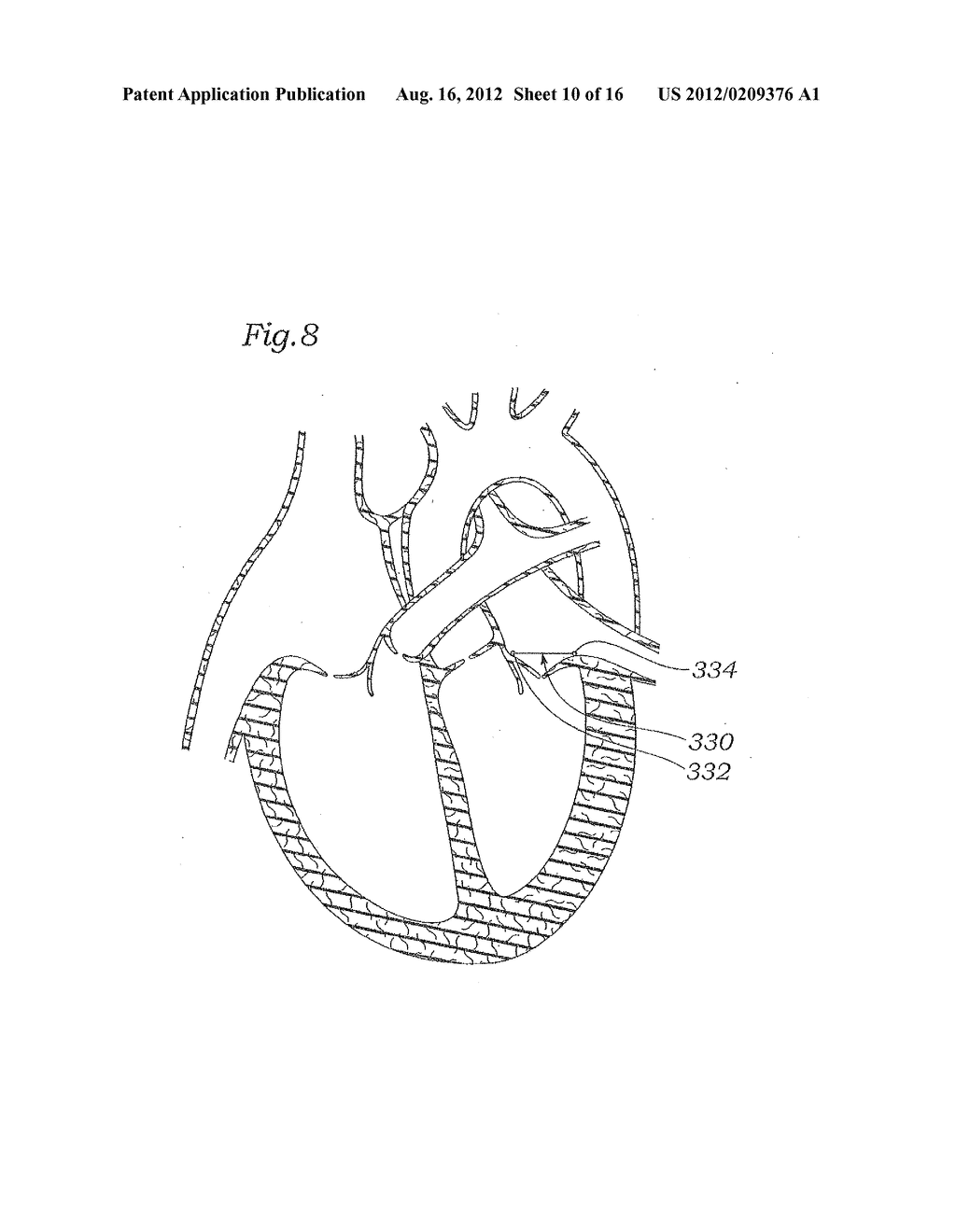 DEVICE AND METHOD FOR RESHAPING MITRAL VALVE ANNULUS - diagram, schematic, and image 11