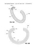 ADJUSTABLE ANNULOPLASTY RING AND ACTIVATION SYSTEM diagram and image