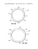 ADJUSTABLE ANNULOPLASTY RING AND ACTIVATION SYSTEM diagram and image