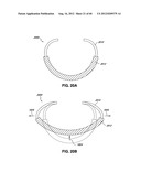 ADJUSTABLE ANNULOPLASTY RING AND ACTIVATION SYSTEM diagram and image