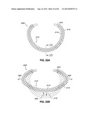 ADJUSTABLE ANNULOPLASTY RING AND ACTIVATION SYSTEM diagram and image