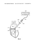 ADJUSTABLE ANNULOPLASTY RING AND ACTIVATION SYSTEM diagram and image