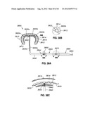 ADJUSTABLE ANNULOPLASTY RING AND ACTIVATION SYSTEM diagram and image