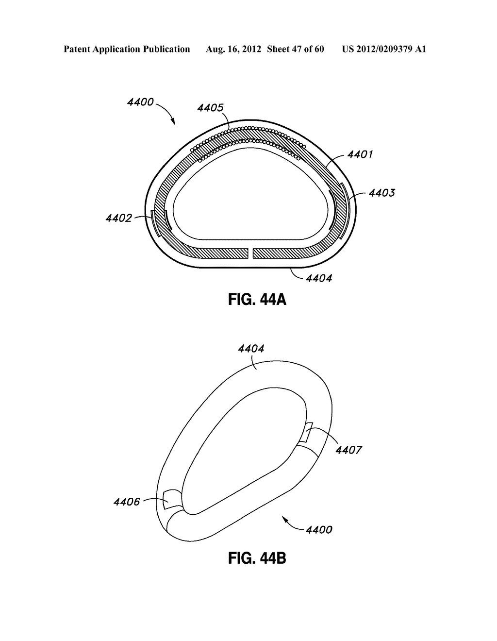 ADJUSTABLE ANNULOPLASTY RING AND ACTIVATION SYSTEM - diagram, schematic, and image 48