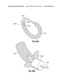 ADJUSTABLE ANNULOPLASTY RING AND ACTIVATION SYSTEM diagram and image