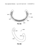 ADJUSTABLE ANNULOPLASTY RING AND ACTIVATION SYSTEM diagram and image