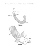 ADJUSTABLE ANNULOPLASTY RING AND ACTIVATION SYSTEM diagram and image