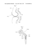 IMPLANTABLE MEDICAL DEVICE AND METHOD OF IMPLANTING THE MEDICAL DEVICE diagram and image