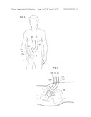 IMPLANTABLE MEDICAL DEVICE AND METHOD OF IMPLANTING THE MEDICAL DEVICE diagram and image