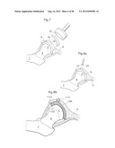 IMPLANTABLE MEDICAL DEVICE AND METHOD OF IMPLANTING THE MEDICAL DEVICE diagram and image