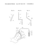 IMPLANTABLE MEDICAL DEVICE AND METHOD OF IMPLANTING THE MEDICAL DEVICE diagram and image