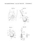 IMPLANTABLE MEDICAL DEVICE AND METHOD OF IMPLANTING THE MEDICAL DEVICE diagram and image