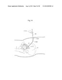 IMPLANTABLE MEDICAL DEVICE AND METHOD OF IMPLANTING THE MEDICAL DEVICE diagram and image