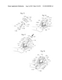 IMPLANTABLE MEDICAL DEVICE AND METHOD OF IMPLANTING THE MEDICAL DEVICE diagram and image