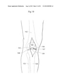 IMPLANTABLE MEDICAL DEVICE AND METHOD OF IMPLANTING THE MEDICAL DEVICE diagram and image