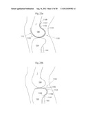 IMPLANTABLE MEDICAL DEVICE AND METHOD OF IMPLANTING THE MEDICAL DEVICE diagram and image