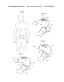 IMPLANTABLE MEDICAL DEVICE AND METHOD OF IMPLANTING THE MEDICAL DEVICE diagram and image