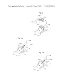 IMPLANTABLE MEDICAL DEVICE AND METHOD OF IMPLANTING THE MEDICAL DEVICE diagram and image