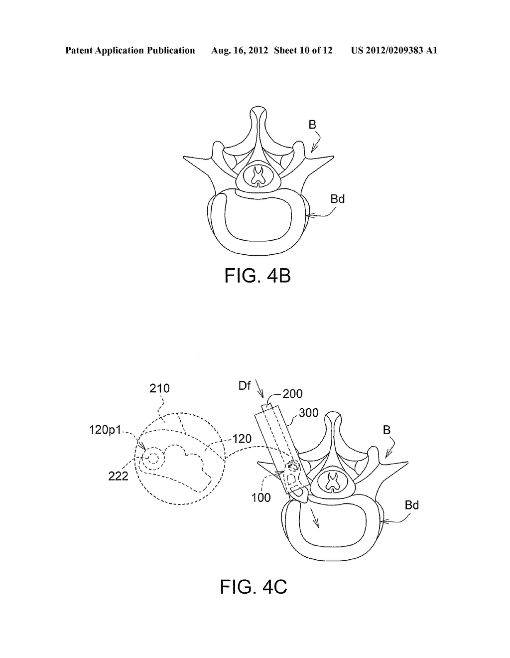 INTERVERTEBRAL CAGE AND IMPLANTING APPARATUS AND OPERATING METHOD THEREOF - diagram, schematic, and image 11