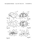 PATELLAR PROSTHESES AND INSTRUMENTATION diagram and image