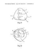 PATELLAR PROSTHESES AND INSTRUMENTATION diagram and image