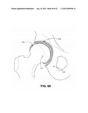 ORTHOPEDIC IMPLANTS HAVING GRADIENT POLYMER ALLOYS diagram and image