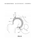 ORTHOPEDIC IMPLANTS HAVING GRADIENT POLYMER ALLOYS diagram and image