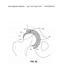 ORTHOPEDIC IMPLANTS HAVING GRADIENT POLYMER ALLOYS diagram and image