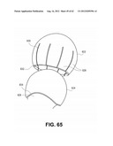 ORTHOPEDIC IMPLANTS HAVING GRADIENT POLYMER ALLOYS diagram and image