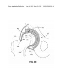 ORTHOPEDIC IMPLANTS HAVING GRADIENT POLYMER ALLOYS diagram and image