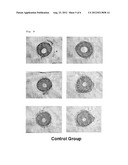 MEDICAL DEVICE FOR PLACEMENT INTO A LUMEN AND MANUFACTURING METHOD THEREOF diagram and image