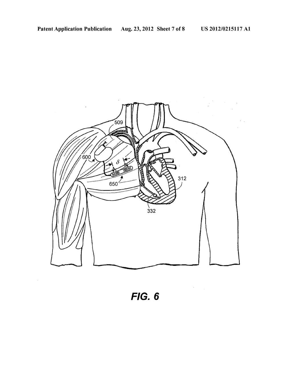 SYSTEMS AND METHODS FOR ESTIMATING CENTRAL ARTERIAL BLOOD PRESSURE OF A     PATIENT - diagram, schematic, and image 08