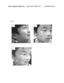 NONINVASIVE CUTANEOUS BLOOD FLOW ASSESSMENT AS A RESPONSE PREDICTOR FOR     VISIBLE LIGHT THERAPY ON SEGMENTAL VITILIGO diagram and image